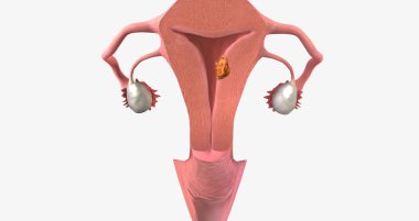 Stage I endometrial cancer begins in the endometrium and spreads to the myometrium of the uterus 3D rendering