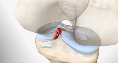 Meniscal root tears are less common than meniscal body tears and frequently go undetected.3D rendering clipart