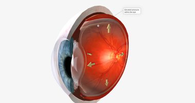 Human eye - glaucoma (eye disease) 3D rendering