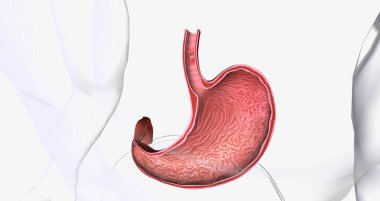 Squamous cell carcinoma, Cancer that forms in the thin, flat cells lining the inside of the esophagus. 3D rendering