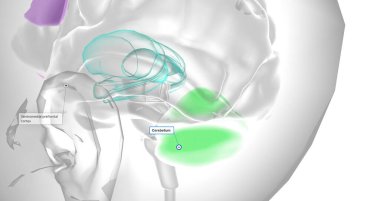 This reduced volume of the prefrontal cortex has been shown to lead to decreased activity levels in other parts of the brain. 3D rendering