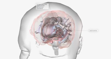 Cerebral palsy is a group of neurological disorders that affect body movement and coordination.3D rendering