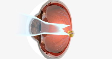 Astigmatism is an eye condition characterized by an oval-shaped cornea and blurry vision.3D rendering