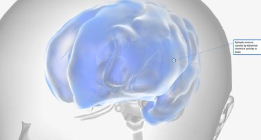 Epileptic seizure caused by abnormal electrical activity in brain 3D rendering