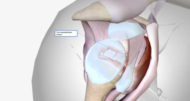 Torn rotator cuff is a musculoskeletal injury that results from damage to the rotator cuff muscles or tendons.3D rendering