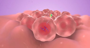 The HER2 Positive Breast Cancer 3D rendering