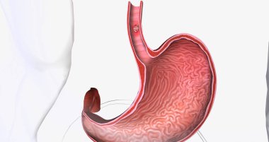 Squamous cell carcinoma, Cancer that forms in the thin, flat cells lining the inside of the esophagus. 3D rendering