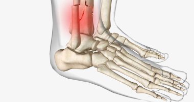 Distal tibia fractures affect the ankle joint and can often involve a fracture of the fibula. 3D rendering