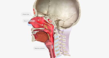 Upper respiratory infections (URIs) are common conditions caused by a viral infection of the respiratory tissue.3D rendering