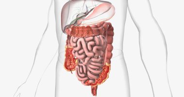 Crohns disease is a type of chronic inflammatory bowel disease. 3D rendering clipart