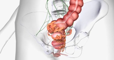Stage IV cancer is characterized by the distant spread of the tumor outside the uterus. 3D rendering