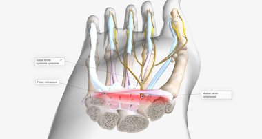 Carpal Tunnel Syndrome - Wrist Pain isolated on white (transparent bones) 3D rendering