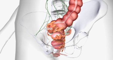 Stage IV cancer is characterized by the distant spread of the tumor outside the uterus. 3D rendering