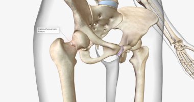 A femoral neck fracture is a type of hip fracture that occurs in the section of the femur closest to the pelvis.3D rendering