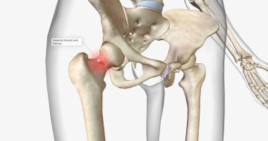 A femoral neck fracture is a type of hip fracture that occurs in the section of the femur closest to the pelvis.3D rendering
