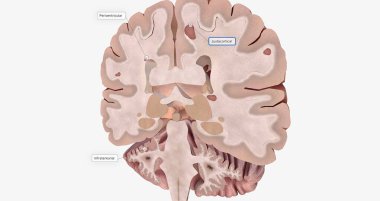 The Brain with lesions 3D rendering