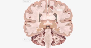 The Brain with lesions 3D rendering