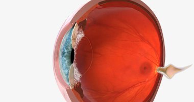 A corneal abrasion, or scratch, is a shallow injury to the surface of the cornea. 3D rendering