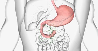 Stage III adenocarcinoma in duodenum 3D rendering