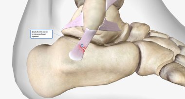 Grade II ankle sprain 3D rendering