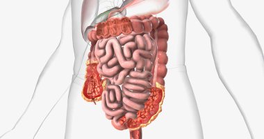 Crohns disease is a type of chronic inflammatory bowel disease. 3D rendering clipart