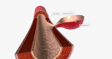 The majority of brain aneurysms are saccular aneurysms that are round and expand from one side of the vessel. 3D rendering