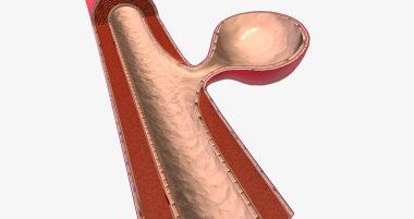 The majority of brain aneurysms are saccular aneurysms that are round and expand from one side of the vessel. 3D rendering