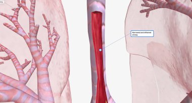 The Narrowed and inflamed airway 3D rendering