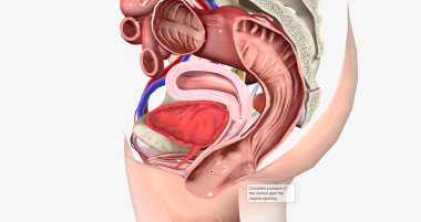 Complete prolapse of the rectum past the vaginal opening 3D rendering