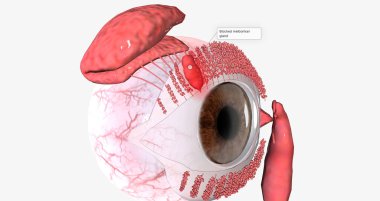 Superficial chalazia form when glands along the edge of the eyelid become infected and blocked. 3D rendering