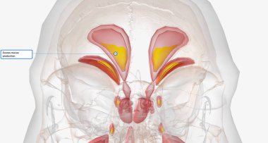 Sinusitis is an infection characterized by inflammation of the paranasal sinuses and excess mucus production. 3D rendering