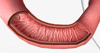 The Duodenal Carcinoma, Stage 0 3D rendering