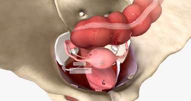 Endometriosis is a condition characterized by the growth of endometrial tissue outside of the uterus. 3D rendering