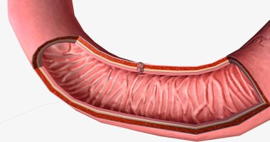 The Stage II duodenal adenoma 3D rendering