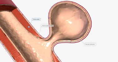 The majority of brain aneurysms are saccular aneurysms that are round and expand from one side of the vessel. 3D rendering
