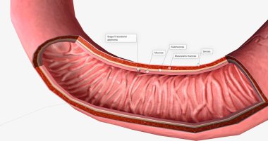 The Duodenal Carcinoma, Stage 0 3D rendering