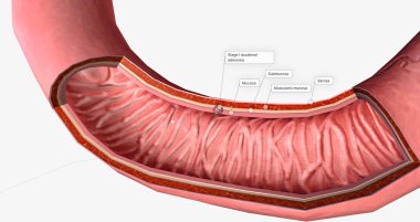 The Stage I duodenal adenoma 3D rendering