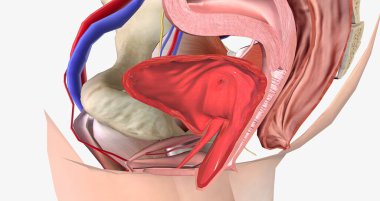 Grade 3 describes a cystocele in which the bulge passes the level of the hymen and is half-way out of the vaginal opening. 3D rendering