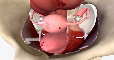 Endometriosis is a condition characterized by the growth of endometrial tissue outside of the uterus. 3D rendering