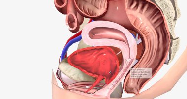 Grade 2 describes a cystocele in which the bulge reaches the level of the hymen, or vaginal opening, without passing it.3D rendering