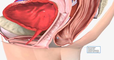 Grade 2 describes a rectocele in which the bulge reaches the level of the hymen, or vaginal opening, without passing it. 3D rendering