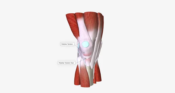 stock image When a tendon is weakened by age or overuse, trauma can cause it to rupture.3D rendering
