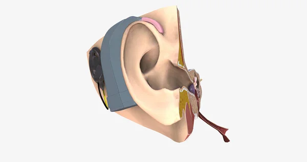 Ett Cochleaimplantat Liten Komplex Elektronisk Apparat Som Kan Bidra Till — Stockfoto