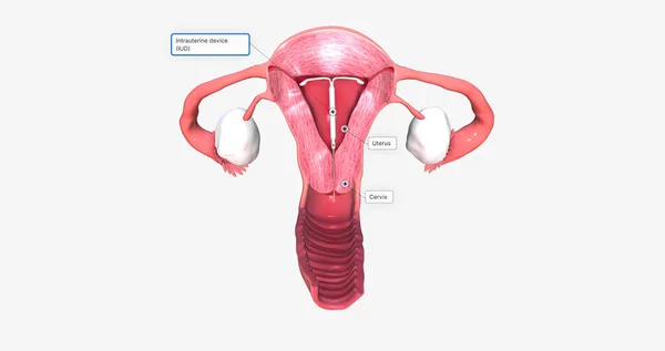 Intra Uterine Device Fantom Uterus Rendering — Photo