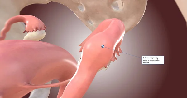 Ectopic pregnancy embryo causes tube rupture 3D rendering