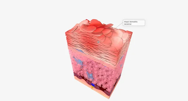 Eczema at the Cellular Level 3D rendering