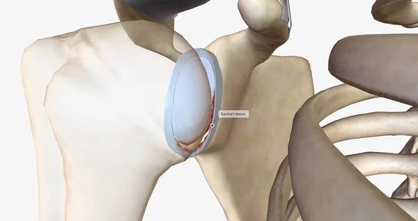 A Bankart lesion occurs as the result of a forward shoulder dislocation.3D rendering