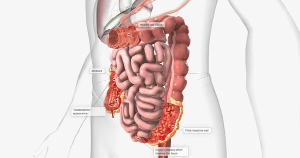 Crohns disease is a type of chronic inflammatory bowel disease. 3D rendering