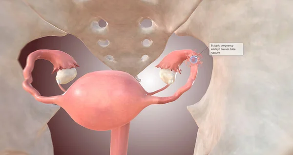 Ectopic pregnancy embryo causes tube rupture 3D rendering
