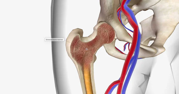 stock image Acute myeloid leukemia (AML) is also known as bone marrow cancer. 3D rendering